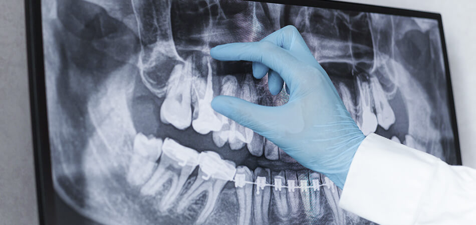 Root canal X-Ray