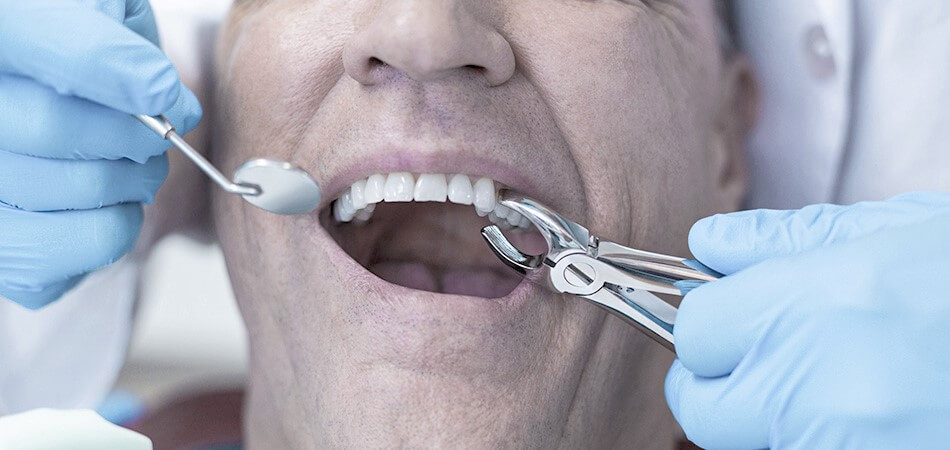 Tooth Extraction